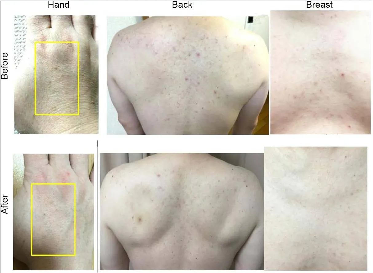 Skin condition improved by hydrogen bath