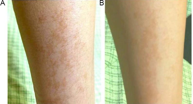 腕のシミのビフォーアフター