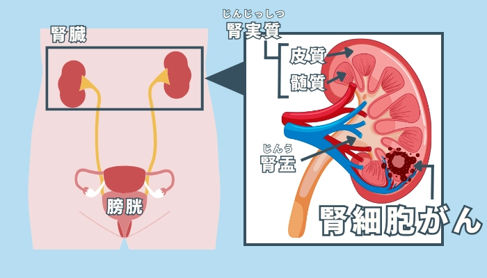 腎臓がんのインフォグラフィックス