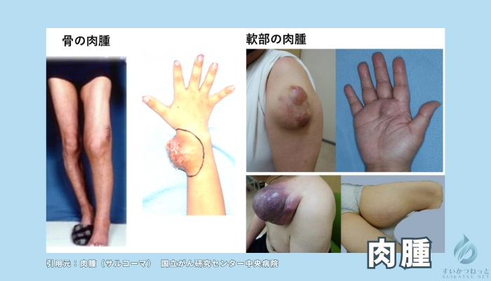 肉腫ってどんな病気？