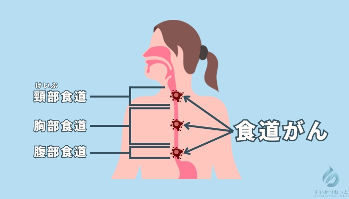 食道がんができる位置