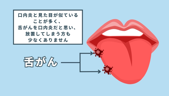 水素吸入と舌がん『舌がんってどんな病気？』