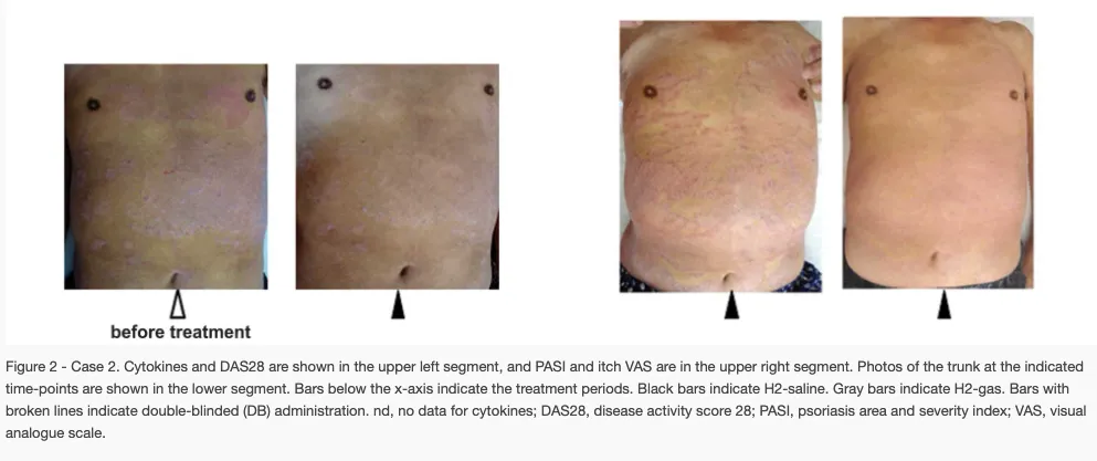 乾癬に対する水素療法の治療効果