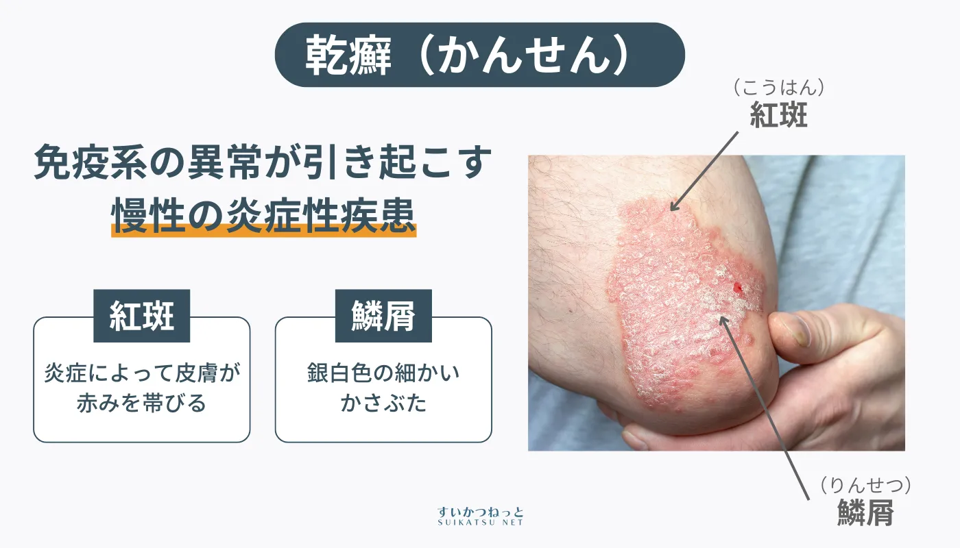観戦は免疫異常によって皮膚に紅斑や鱗屑が現れる慢性の炎症性疾患