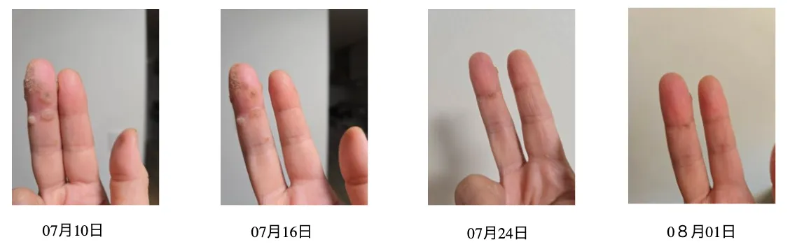 乳がんで闘病中の方の水素吸入体験談（火傷の痕が改善している）