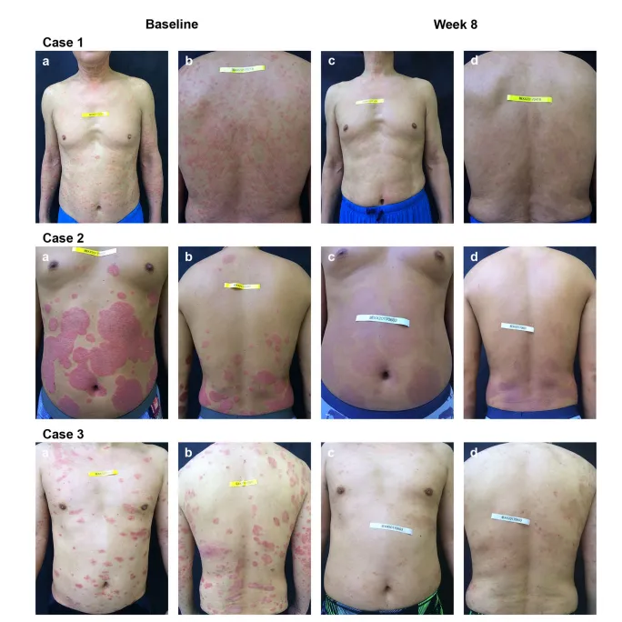 Positive effects of hydrogen-water bathing in patients of psoriasis and parapsoriasis en plaques(乾癬および類乾癬患者における水素水浴の有効性)のFigure1で示されている8週間後の症状の変化