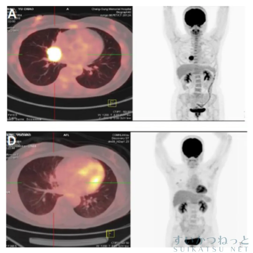 水素吸入開始から2.5か月後の画像で、腫瘍が画像上消失している。この患者は化学療法を拒否し、水素吸入のみで治療を行った。（Chen et al., 2019, Fig.2A, Dより引用）