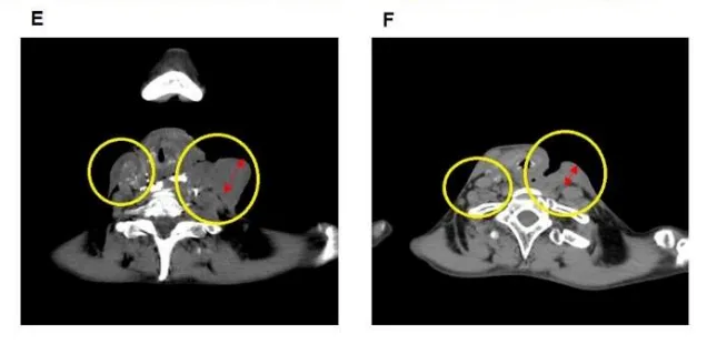 下咽頭がんの治療前後のCT画像（Yorozu et al., 2022, Fig.3より引用）